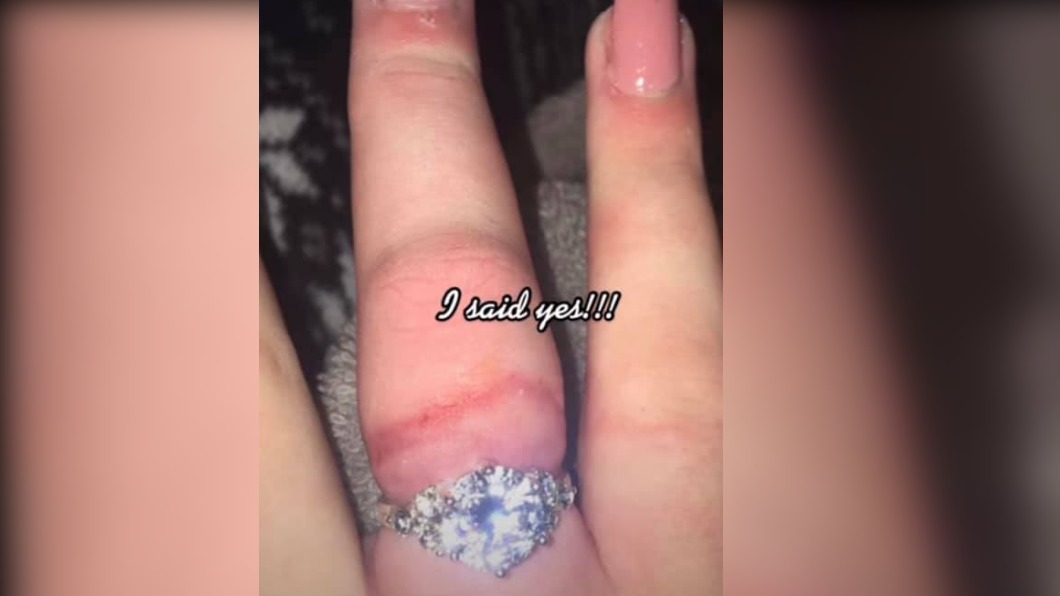 一名女子將手上戴的戒指硬擠進手指內，導致手指宛如大腸圈。（圖／翻攝自臉書）