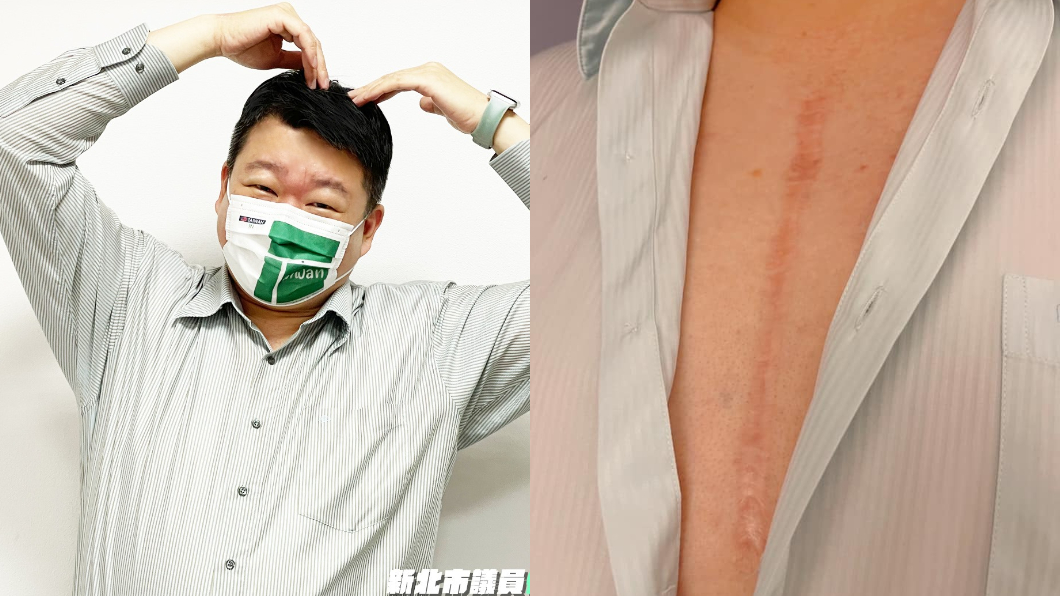 新北市議員何博文自揭20公分傷疤，親曝沒當兵原因。（圖／翻攝自何博文臉書）