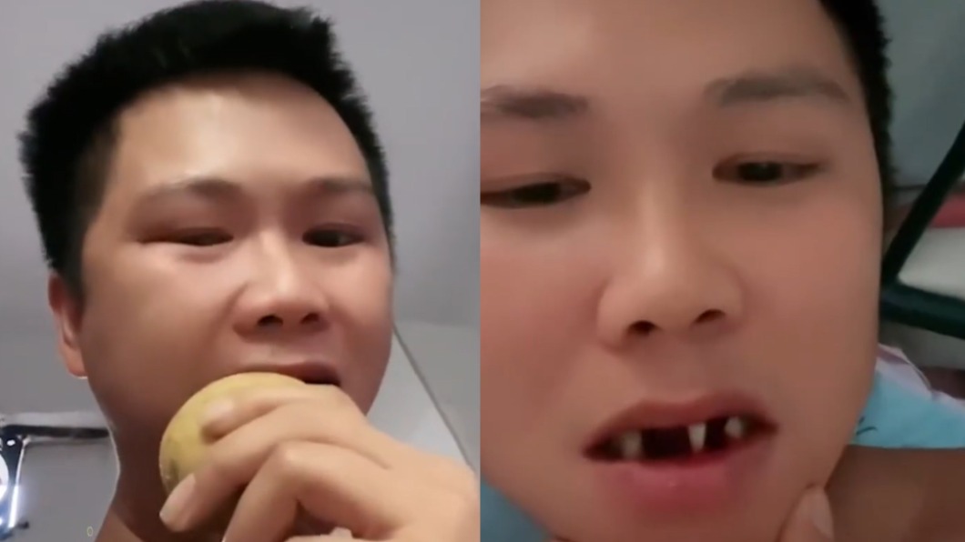 男子吃完凍土豆拔3顆牙。（圖／翻攝自微博）