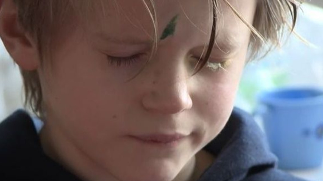 9歲的魯伯特雙眼遭強力膠黏住。（圖／翻攝自Yorkshire Air Ambulance）