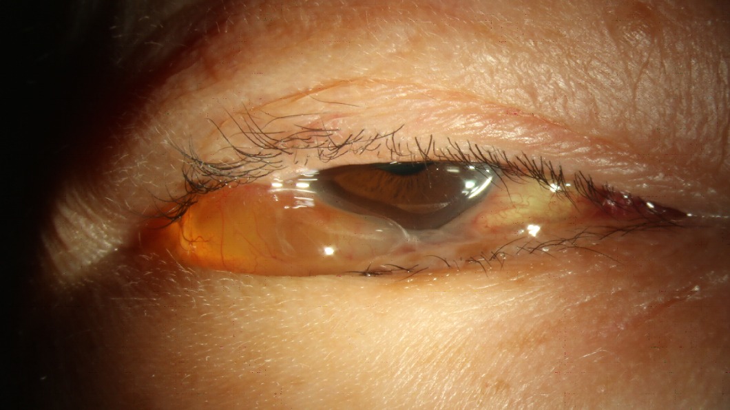 患者右眼嚴重腫脹還發燒，檢查竟是鼻竇炎惹禍。（圖／院方提供）