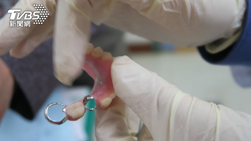 阿嬤的假牙內鉤變形摩擦導致舌癌。（圖／中央社）