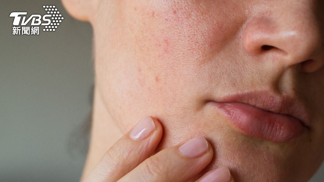 異位性皮膚炎常常影響生活作息。（示意圖／shutterstock達志影像）