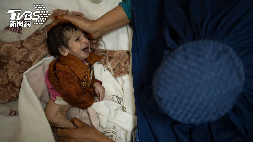 阿富汗兩個月大的男嬰營養不良、體重過輕，在醫院接受治療。（圖／達志影像美聯社）