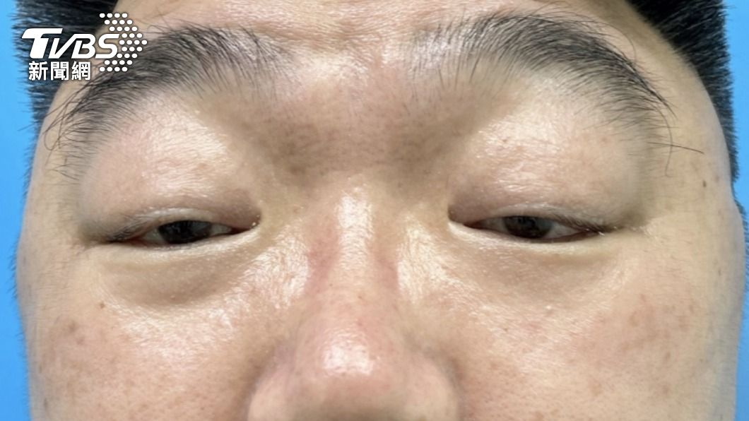 江先生先天眼瞼下垂，小時候常被老師誤以為上課偷睡覺。（圖／高醫提供）