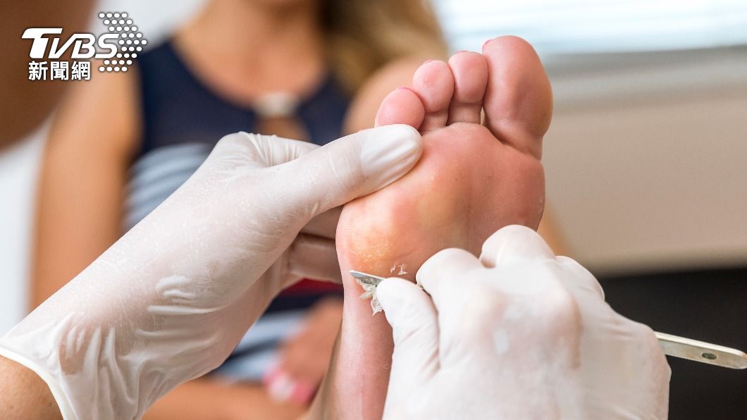 若腳趾出現增厚、變硬，有可能是病毒疣，建議盡早就醫治療。（示意圖／shutterstock達志影像）