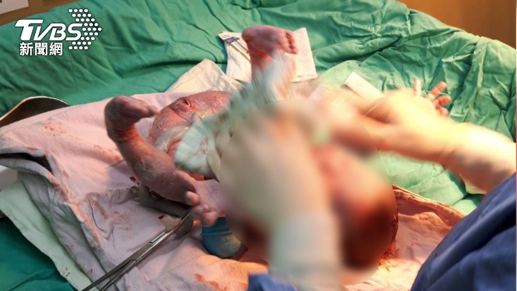 產婦在分娩過程中，發生臍帶脫垂，險讓嬰兒缺氧。（圖／院方提供）