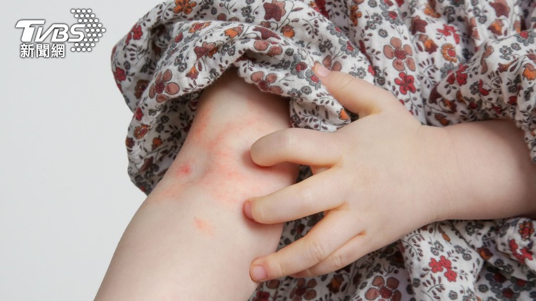 罹患異位性皮膚炎的患者多數都是在嬰幼兒時期發生。（示意圖／shutterstock達志影像）