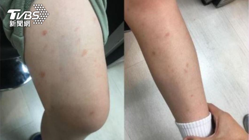 孩子雙腿出現紅疹，經診斷為過敏性紫斑症。（圖／診所提供）