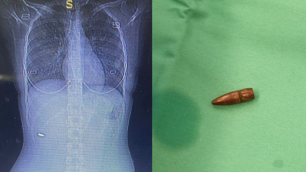 約旦女子背部不適，3個月後才發現脊椎附近卡彈。（圖／翻攝自@glick_sh  Twitter）