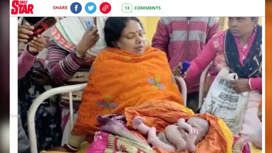 印度誕生4隻手、4隻腳嬰兒。（圖／翻攝自《Daily Star》） 