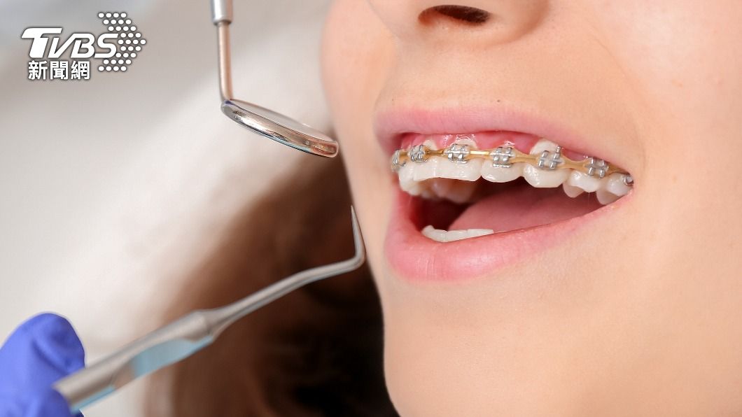 牙齒矯正在年輕人當中越來越普及。（示意圖／shutterstock達志影像）