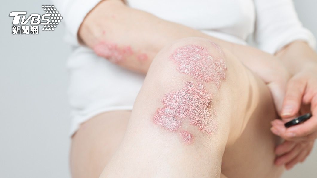 乾癬會造成皮膚慢性發炎。（示意圖／shutterstock達志影像）