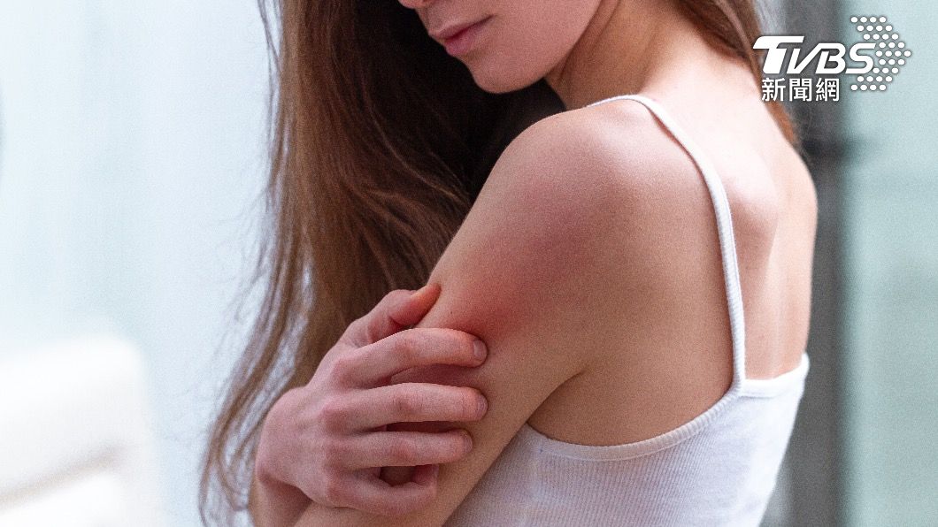 乾癬不只是會出現皮膚症狀的疾病，它其實是一種全身性的免疫疾病。（示意圖／shutterstock達志影像）