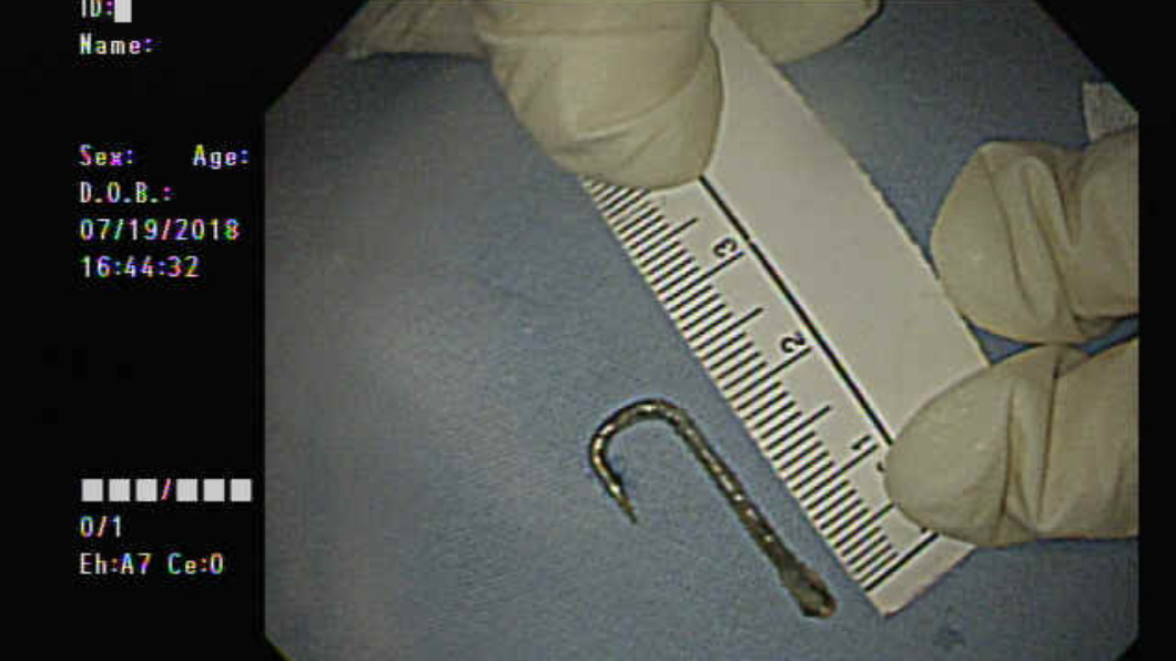 醫師高崧碩從婦人喉嚨取出長達近2.5公分的魚鉤。　圖／高崧碩醫師提供