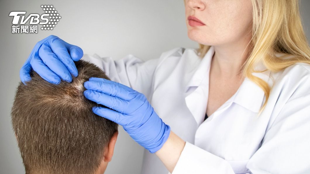 長在頭頂的痘痘清除步驟相當重要，一不小心就有可能導致局部禿頭。（示意圖／shutterstock達志影像）
