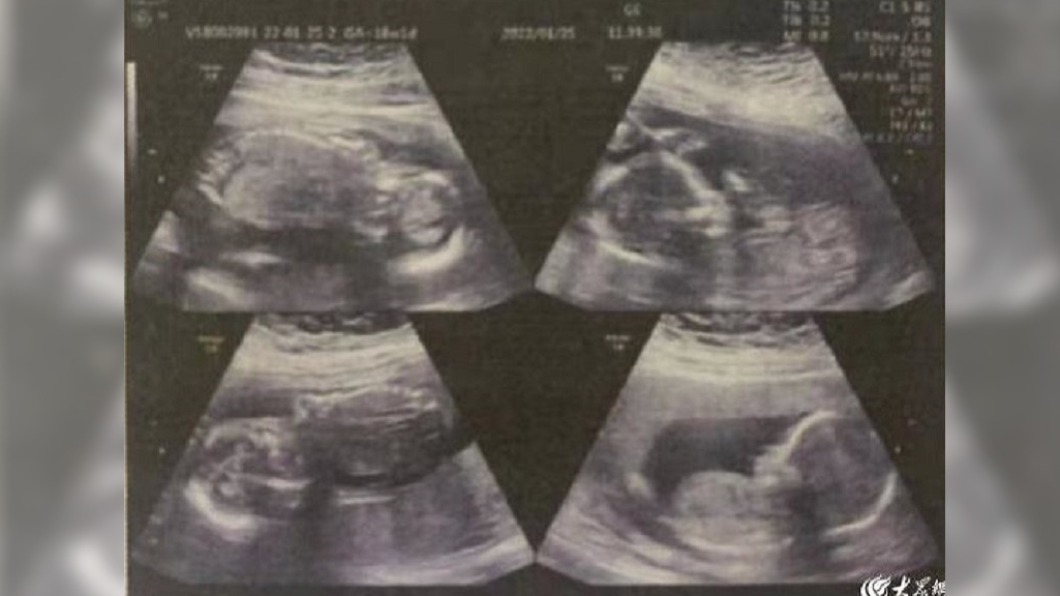 4胞胎已產下2個，另外2子還在母親腹中。（圖／翻攝自《海報新聞》）