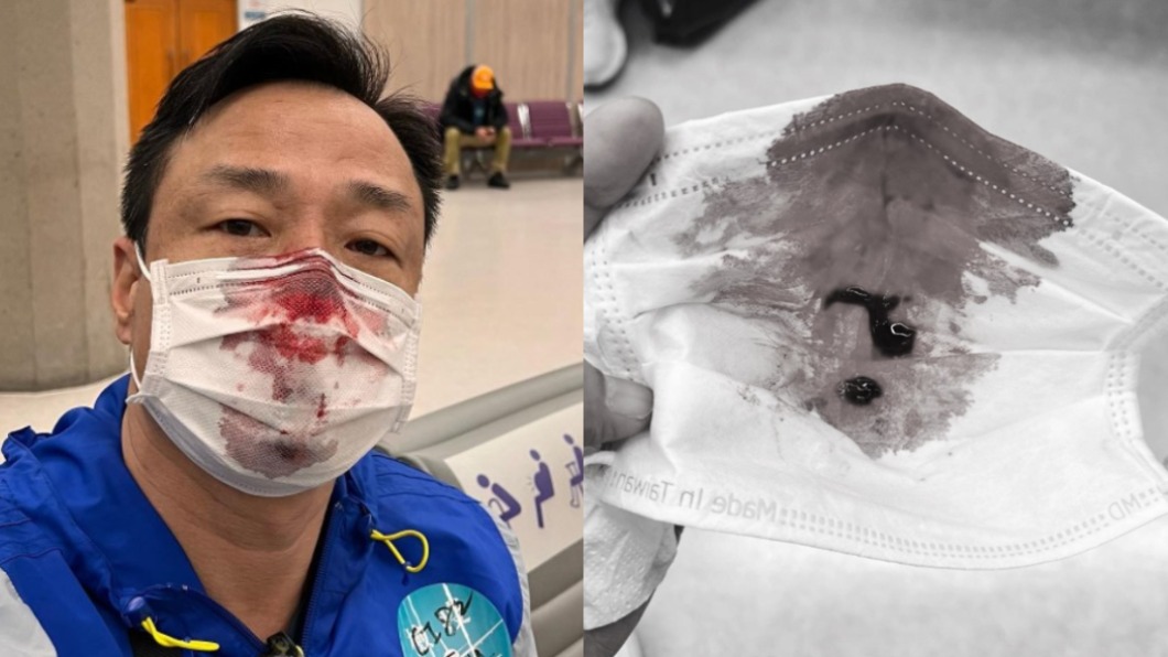 王喜入境台灣進行PCR時意外被捅傷。（圖／翻攝自王喜IG，圖片經變色處理）
