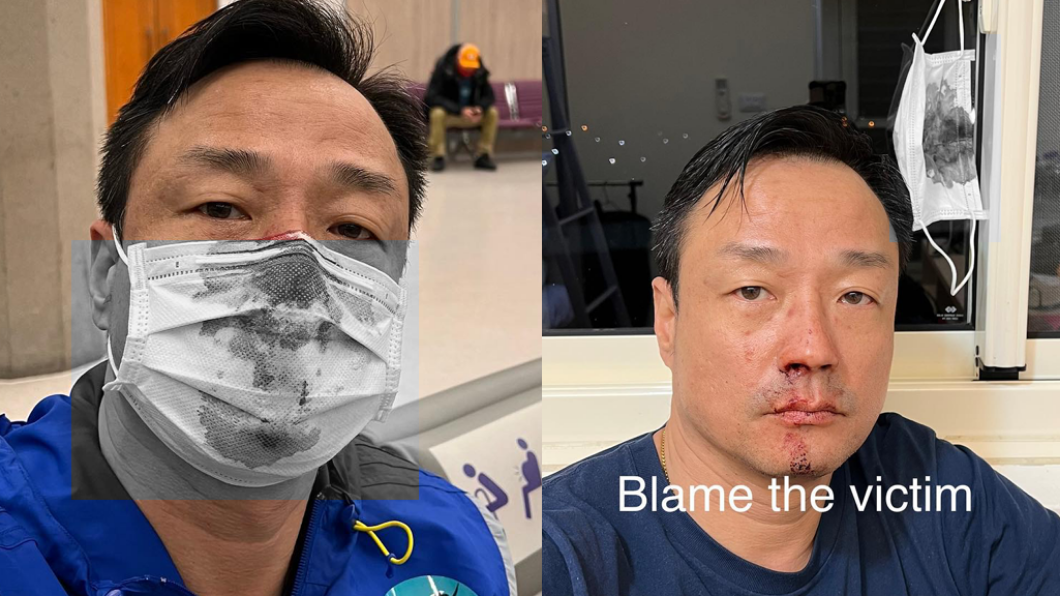香港演員做PCR遭戳流鼻血引發軒然大波。（圖／翻攝自王喜臉書）