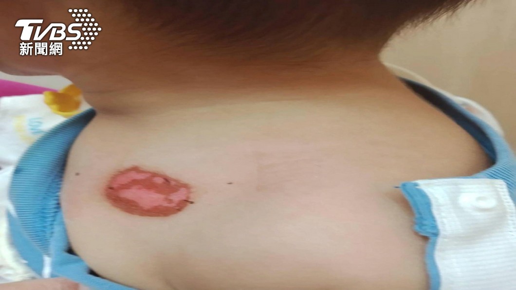圖／TVBS 戴「二氧化氯錠」童脖子灼傷　醫：皮膚敏感群留意