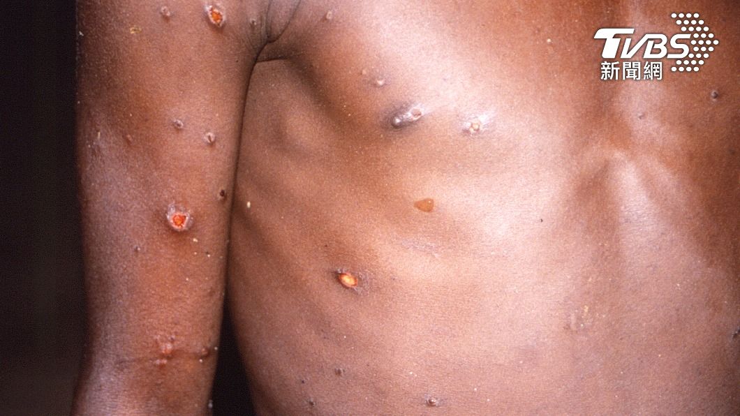 猴痘近期在全球出現多起案例。（圖／達志影像美聯社） 全球逾200例猴痘疑「不尋常傳播」　世衛憂恐剛開始