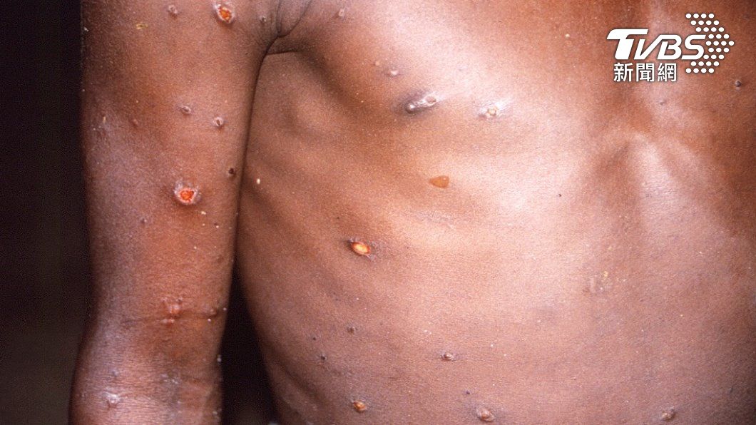 猴痘。（照片來源：AP）