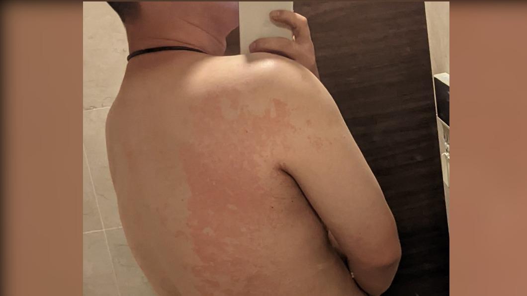 陳柏惟貼出照片顯示，他背上有一大片的紅斑。（圖／翻攝自陳柏惟臉書）