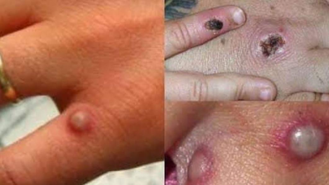 巴西證實5宗境內感染猴痘病例。（圖／翻攝NupekoTv~Lafiagi Twitter）