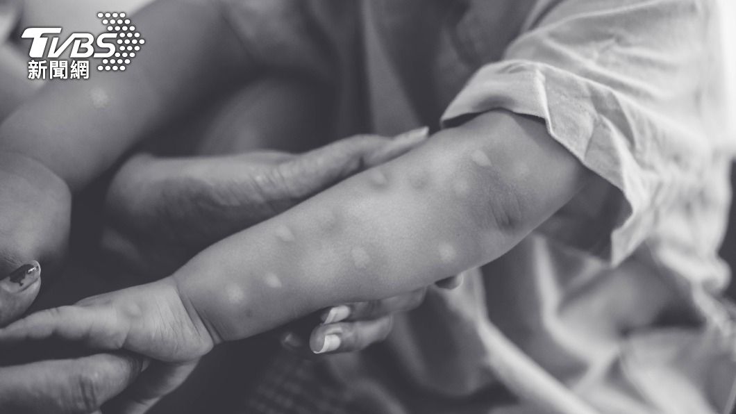 法國出現首名兒童感染猴痘。（示意圖／shutterstock達志影像） 首名兒童確診猴痘！病毒12倍速突變　專家：問題大了