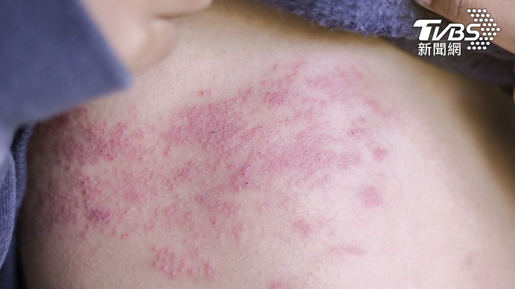 皰疹有兩大類型。（示意圖／shutterstock 達志影像） 「皰疹不等於性病」！　醫科普：童年2習慣常感染