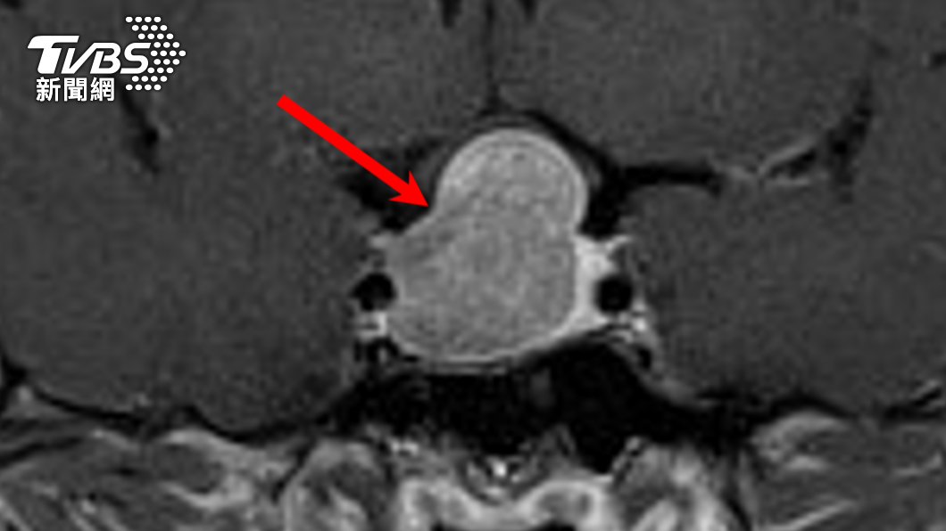 患者術前進行腦部核磁共振影像，發現腦下垂體腫瘤。（圖／院方提供）