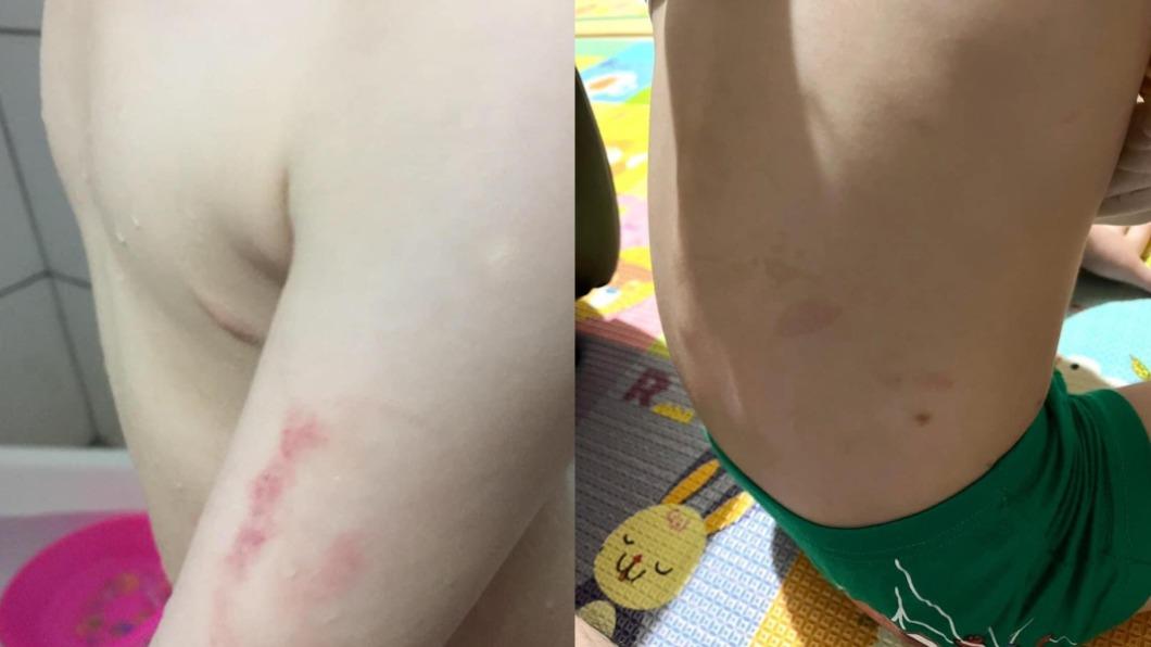 男童身上有多處瘀傷。（圖／翻攝自臉書） 4歲男童滿身傷！桃市幼兒園驚爆虐童　一查老師竟無照