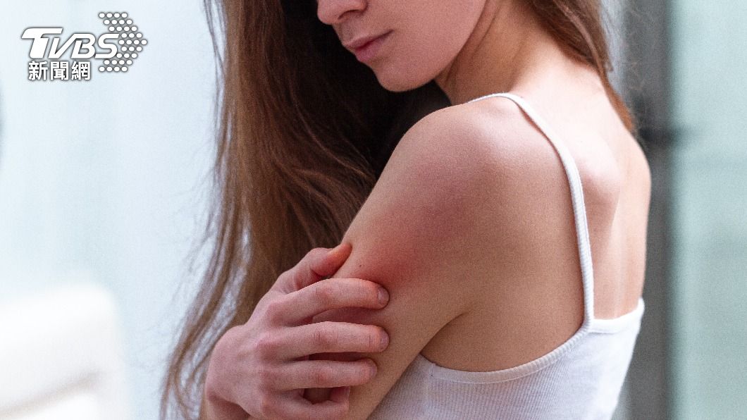 異位性皮膚炎往往反覆發作，半數在兒童、青少年時期發病。（示意圖，非當事人／shutterstock達志影像）