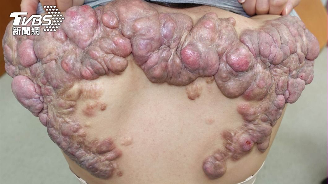 27歲女性背著長出2顆青春痘後，15年間竟變成長出半公斤重的蟹足腫。（圖／長庚醫院提供）
