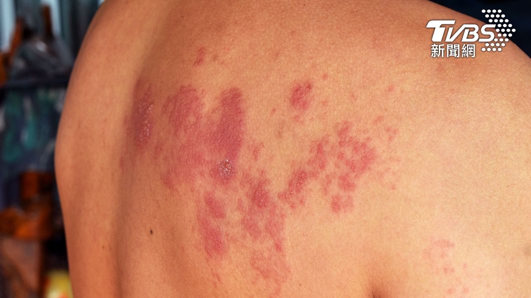 帶狀皰疹好發在免疫力下降患者。（圖／TVBS)