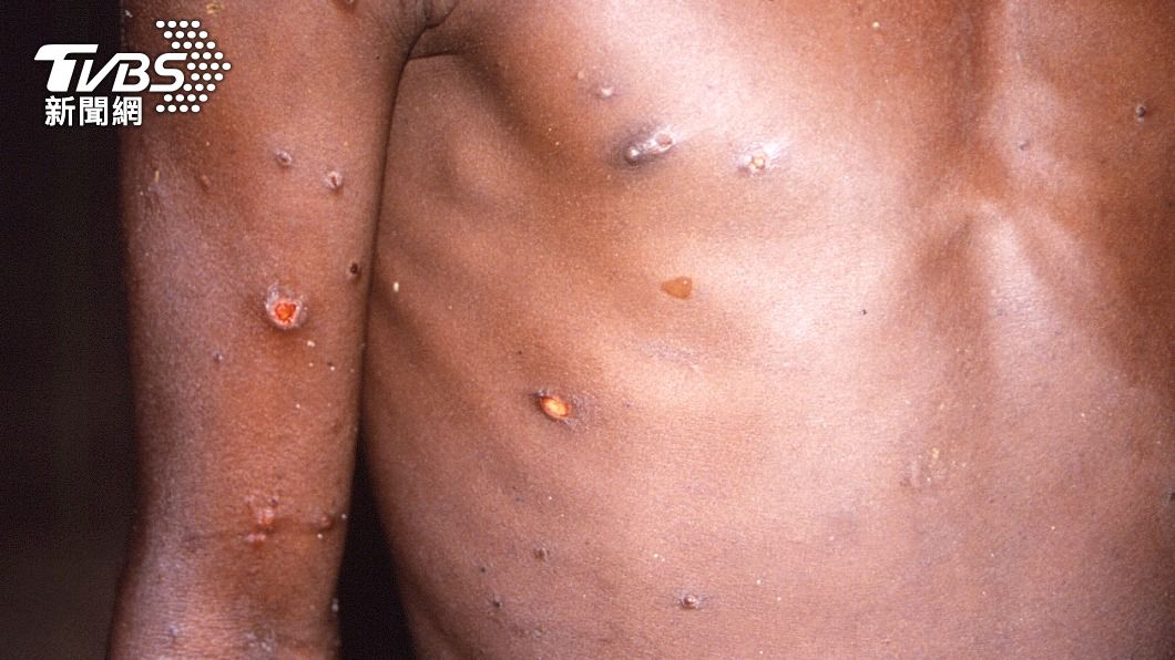 美國猴痘病例數量暴增。（示意圖。圖／達志影像美聯社）