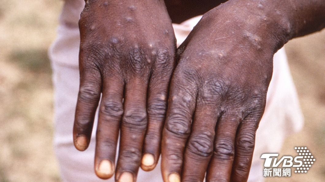 研究人員在剛果發現居民感染猴痘的症狀。（圖/達志影像美聯社）
