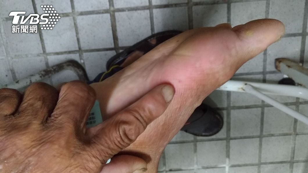 老翁洗澡時腳被虎頭蜂螫傷。（圖／TVBS）