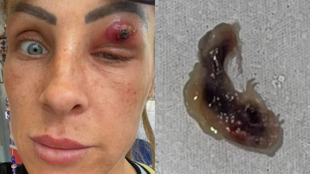 英國一名女子日前眼皮突然腫脹結果熱水淋傷口竟竄出一隻異形寄生蟲。（圖／翻攝自Louise Edwards臉書）