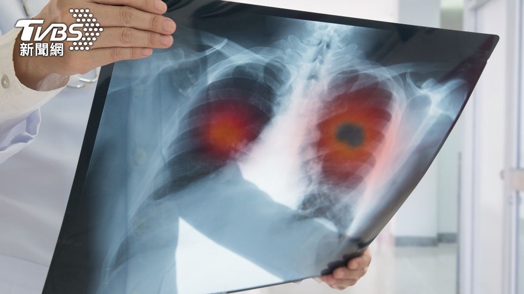 Lung cancer takes the lead on Taiwan’s cancer list in 2021(Shutterstock) Lung cancer takes the lead on Taiwan’s cancer list in 2021
