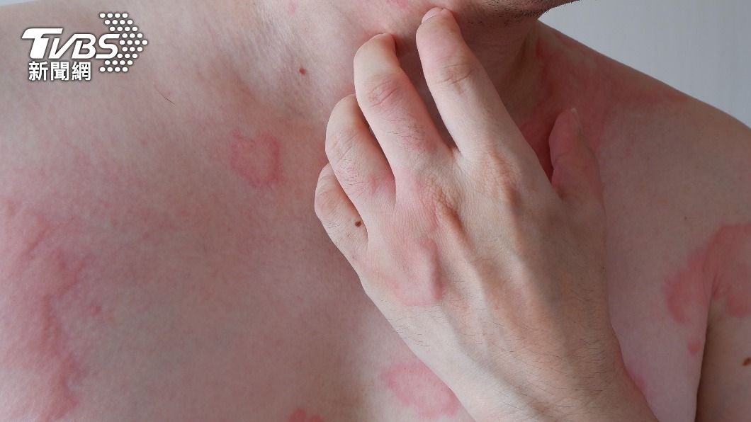 身上疹子最常見於腹、腰、肩頸、手臂、腋下及大腿內側。（示意圖／shutterstock達志影像）