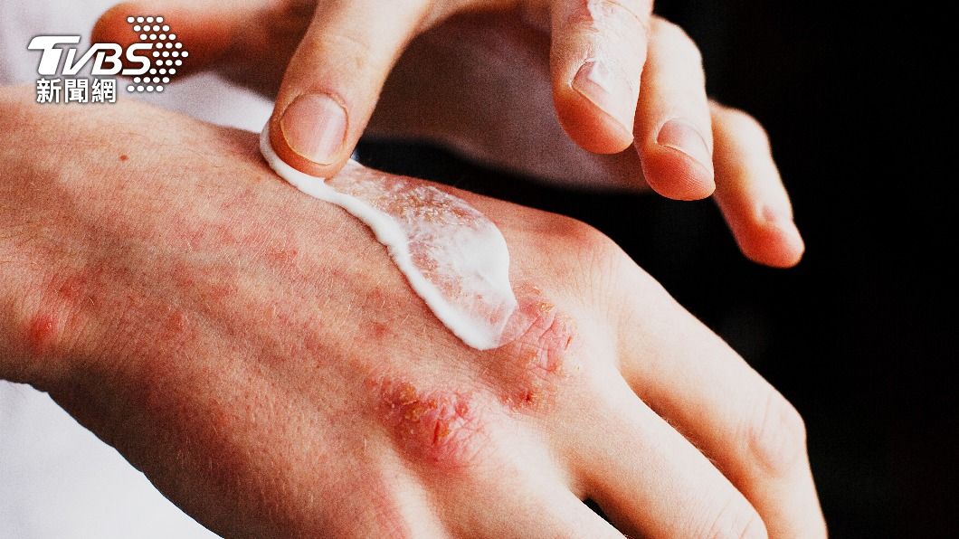 老翁2年間濕疹不斷復發，檢查竟是罹患皮膚癌。（示意圖／shutterstock達志影像）
