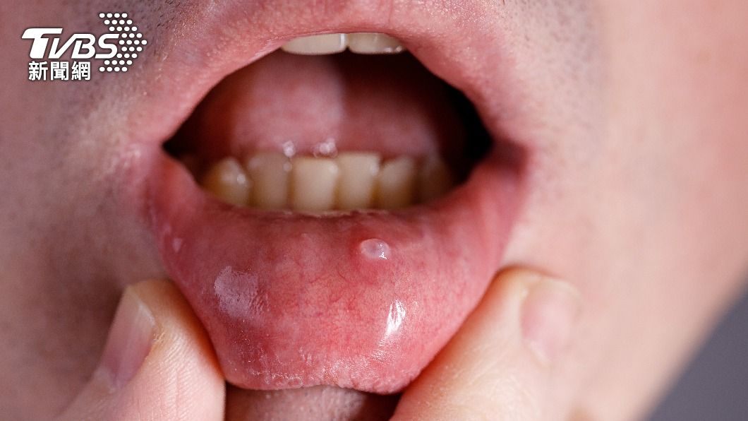 營養不足、壓力過大皆可能造成嘴破。（示意圖／shutterstock 達志影像）