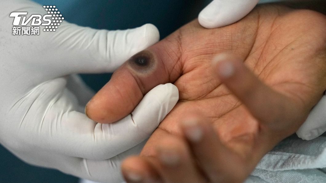 全球猴痘感染病例已突破5萬。（圖／達志影像美聯社）