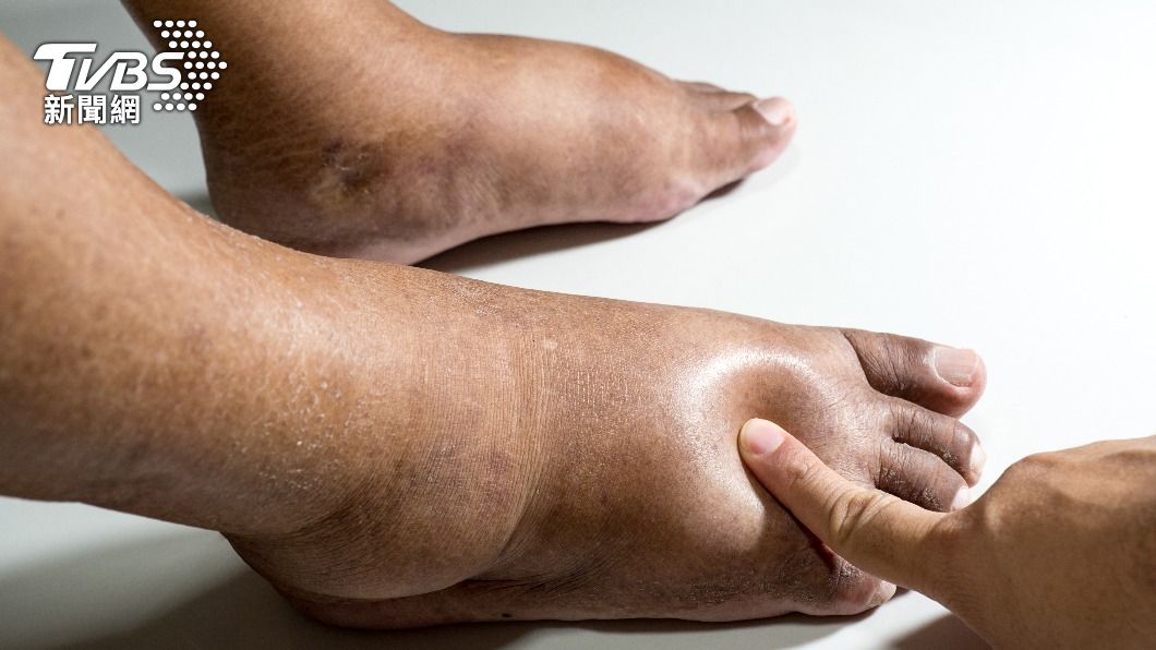 腿皮膚粗糙、皮膚黯沈又腫大原來是靜脈疾病。（示意圖／shutterstock達志影像）