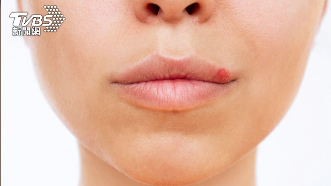 唇疱疹刺癢又疼痛，而且經常反覆發作。（示意圖／shutterstock達志影像）