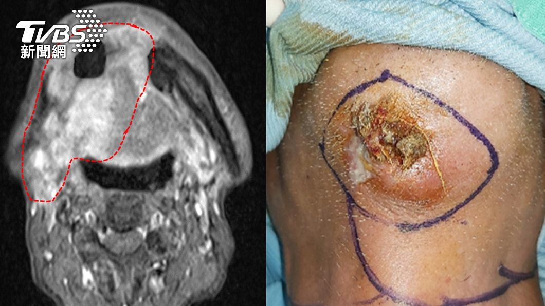 51歲男子因舌頭潰瘍，久而未痊癒。圖左為核磁共振顯示嚴重的腫瘤侵犯；圖右為癌症侵犯下巴骨頭及皮膚。