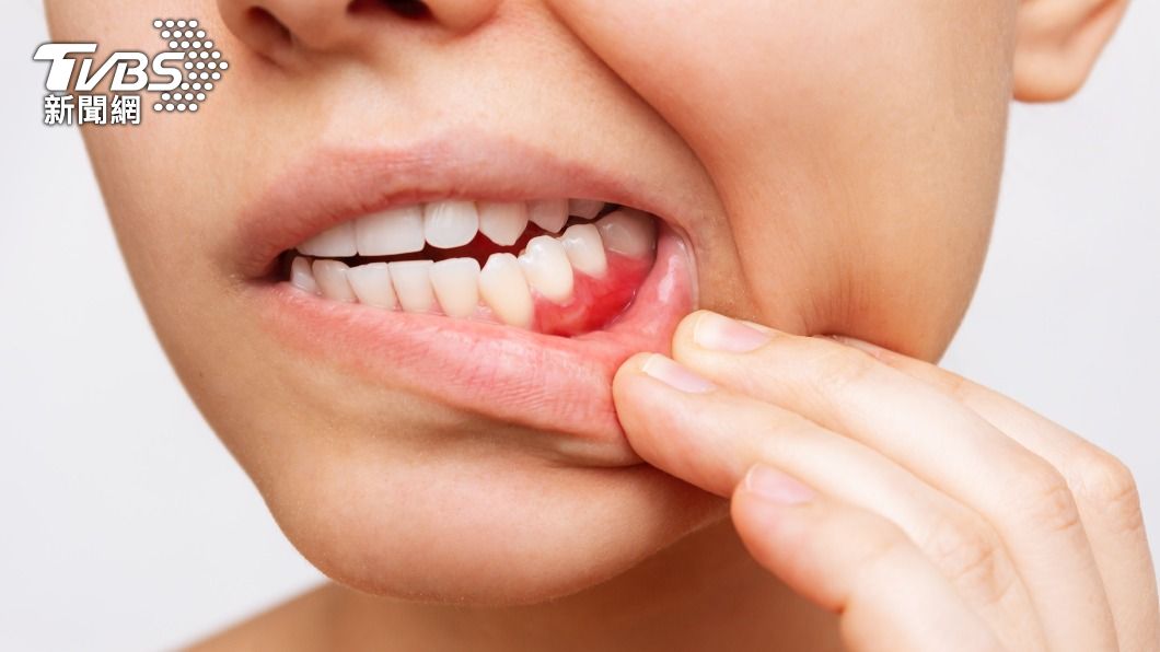 牙齦出血不一定是牙齒的問題。（示意圖／shutterstock達志影像）