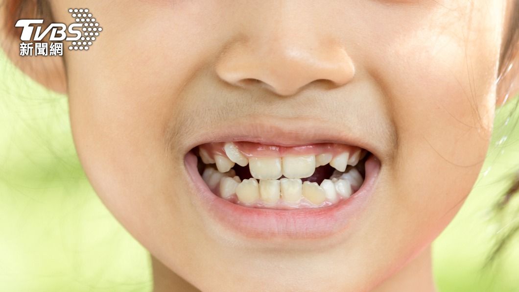 沒注意孩童牙齒可能會越長越歪。（示意圖／shutterstock達志影像）