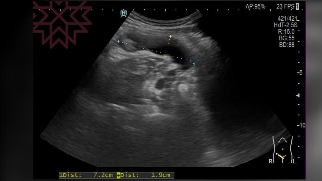 從超音波照就可以在男子腹腔發現一顆腫瘤。（圖／翻攝自林相宏臉書）